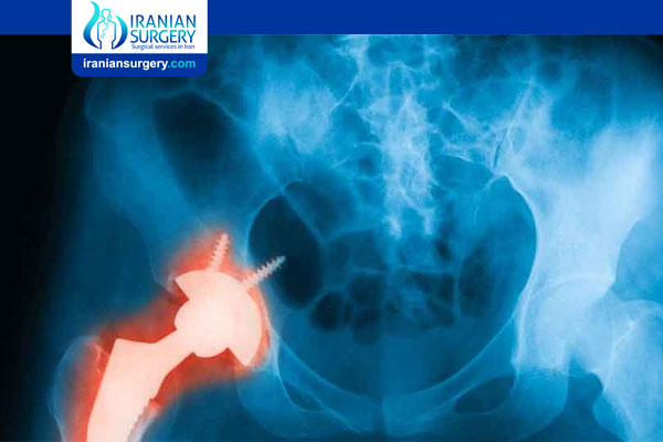 reasons-not-to-have-hip-replacement-iranian-surgery