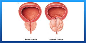 الشباب البروستاتا عند كيفية علاج