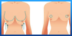 breast reduction in iran