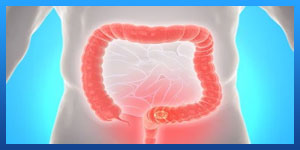 colon cancer stages 4 photos