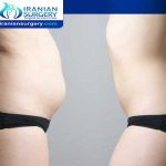 How Many Sizes Do You Go Down After Liposuction?