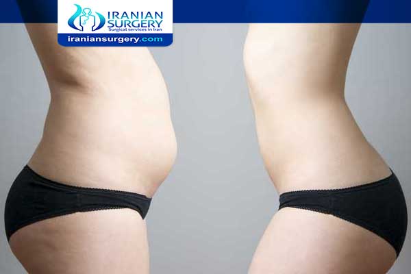 How Many Sizes Do You Go Down After Liposuction?