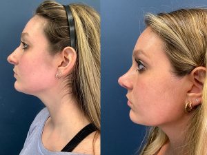 rhinoplasty swelling stages