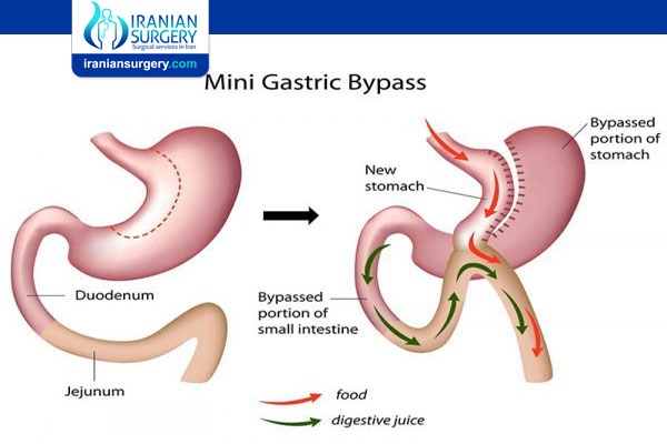 Mini gastric bypass VS gastric bypass