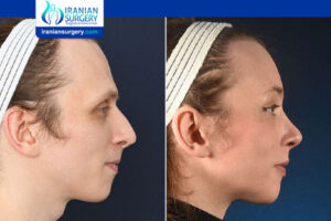 What Is Type 3 Facial Feminization Surgery?