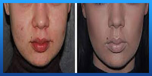 After Buccal Fat Removal Procedure