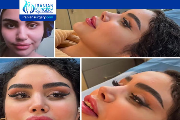 What should I know before getting rhinoplasty in Iran?