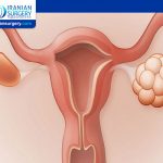 Uterine Fibroids