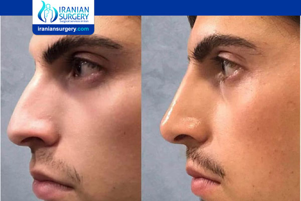 Does Non-Surgical Rhinoplasty Last Forever?