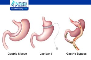 What is the Success Rate of Bariatric Surgery?