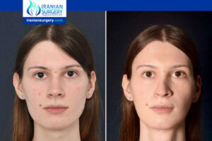 What Is Facial Feminization Surgery for CIS Female?