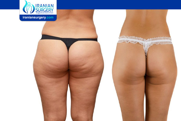 Can Bad Liposuction be fixed?