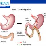 Long-Term Effects of Mini Gastric Bypass