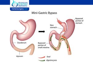 Long-Term Effects of Mini Gastric Bypass