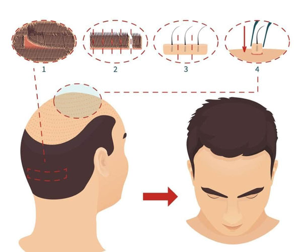 ما هي عملیة زراعة الشعر؟