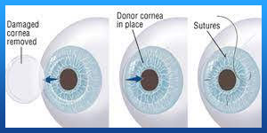 Cornea transplant in Iran