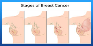 early stage breast cancer treatment