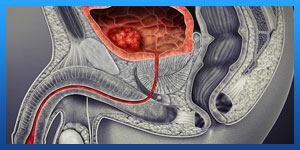 bladder cancer symptoms in men