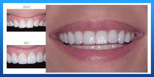 Dental Veneers after 10 Years