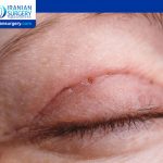Signs of infection after blepharoplasty