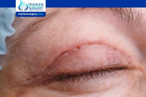 Signs of infection after blepharoplasty