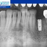 Adjacent Tooth Pain After Implant