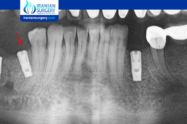 Adjacent Tooth Pain After Implant