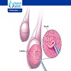 Microscopic Testicular Sperm Extraction (MicroTESE) in Iran