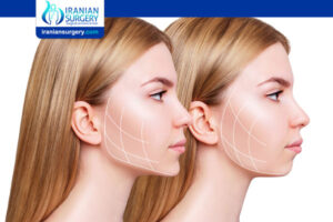 Square Jaw Reduction Surgery