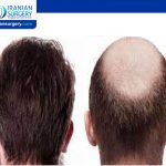 نسبة نجاح عملية زراعة الشعر