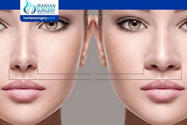 Rhinoplasty For Wide Nose