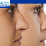 ايجابيات عملية تجميل الأنف