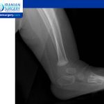 Club Foot Radiology