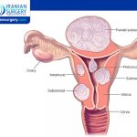 Uterine Fibroids Symptoms