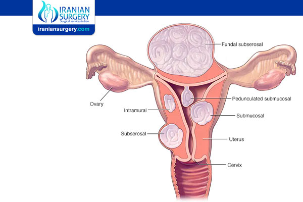 Uterine Fibroids Causes