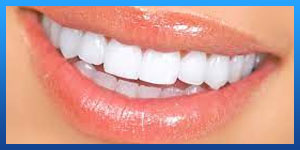 Why do veneers need to be replaced?