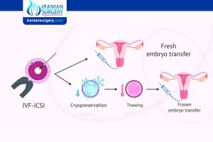 Frozen Embryo Transfer (FET) Timeline  Iranian Surgery