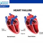 Heart Failure Symptoms Heart failure — sometimes known as congestive heart failure — occurs when the heart muscle doesn't pump blood as well as it should. When this happens, blood often backs up and fluid can build up in the lungs, causing shortness of breath. Certain heart conditions, such as narrowed arteries in the heart (coronary artery disease) or high blood pressure, gradually leave the heart too weak or stiff to fill and pump blood properly. In this article we will review some of the most commons symptoms of heart failure. Heart Failure Symptoms This table lists the most common signs and symptoms, explains why they occur and describes how to recognize them. Sign or Symptom People with Heart Failure May Experience... Why It Happens Shortness of breath (also called dyspnea) ...breathlessness during activity (most commonly), at rest, or while sleeping, which may come on suddenly and wake you up. You often have difficulty breathing while lying flat and may need to prop up the upper body and head on two pillows. You often complain of waking up tired or feeling anxious and restless. Blood "backs up" in the pulmonary veins (the vessels that return blood from the lungs to the heart) because the heart can't keep up with the supply. This causes fluid to leak into the lungs. Persistent coughing or wheezing ...coughing that produces white or pink blood-tinged mucus. Fluid builds up in the lungs (see above). Buildup of excess fluid in body tissues (edema) ...swelling in the feet, ankles, legs or abdomen or weight gain. You may find that your shoes feel tight. As blood flow out of the heart slows, blood returning to the heart through the veins backs up, causing fluid to build up in the tissues. The kidneys are less able to dispose of sodium and water, also causing fluid retention in the tissues. Tiredness, fatigue ...a tired feeling all the time and difficulty with everyday activities, such as shopping, climbing stairs, carrying groceries or walking. The heart can't pump enough blood to meet the needs of body tissues. The body diverts blood away from less vital organs, particularly muscles in the limbs, and sends it to the heart and brain. Lack of appetite, nausea ...a feeling of being full or sick to your stomach. The digestive system receives less blood, causing problems with digestion. Confusion, impaired thinking ...memory loss and feelings of disorientation. A caregiver or relative may notice this first. Changing levels of certain substances in the blood, such as sodium, can cause confusion. Increased heart rate ...heart palpitations, which feel like your heart is racing or throbbing. To "make up for" the loss in pumping capacity, the heart beats faster. When to see a doctor See your doctor if you think you might be experiencing signs or symptoms of heart failure. Call 911 or emergency medical help if you have any of the following: . Chest pain . Fainting or severe weakness . Rapid or irregular heartbeat associated with shortness of breath, chest pain or fainting . Sudden, severe shortness of breath and coughing up white or pink, foamy mucus Although these signs and symptoms may be due to heart failure, there are many other possible causes, including other life-threatening heart and lung conditions. Don't try to diagnose yourself. Emergency room doctors will try to stabilize your condition and determine if your symptoms are due to heart failure or something else. If you have a diagnosis of heart failure and if any of the symptoms suddenly become worse or you develop a new sign or symptom, it may mean that existing heart failure is getting worse or not responding to treatment. This may also be the case if you gain 5 pounds (2.3 kilograms) or more within a few days. Contact your doctor promptly. About Iranian Surgery Iranian surgery is an online medical tourism platform where you can find the best heart surgeons in Iran. The price of Heart Surgery in Iran can vary according to each individual’s case and will be determined by an in-person assessment with the doctor. For more information about the cost of Heart Surgery in Iran and to schedule an appointment in advance, you can contact Iranian Surgery consultants via WhatsApp number 0098 901 929 0946. This service is completely free. Source: https://www.mayoclinic.org/diseases-conditions/heart-failure/symptoms-causes/syc-20373142 https://www.heart.org/en/health-topics/heart-failure/warning-signs-of-heart-failure