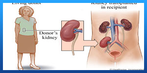 Kidney Transplant in iran