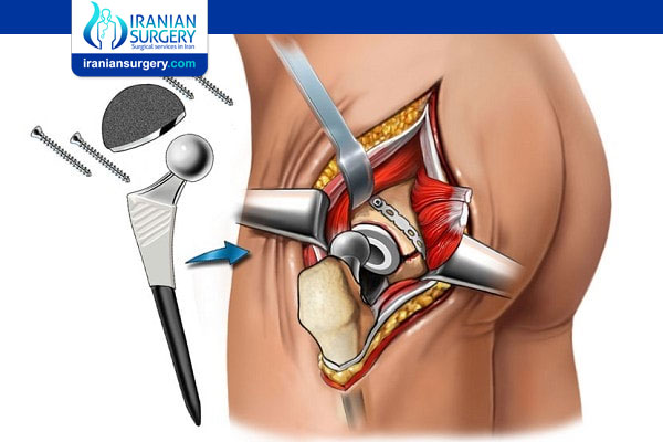 Which Method of Hip Replacement Is the Best?