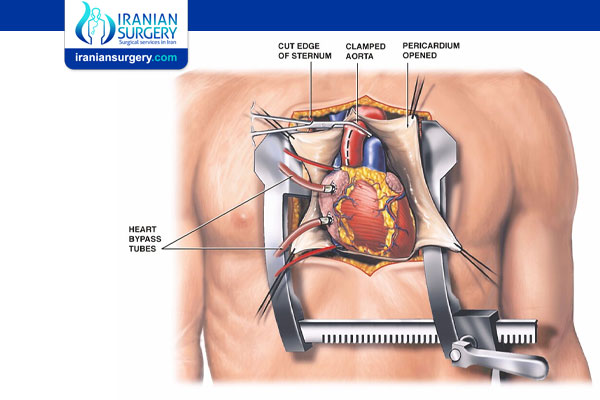 Heart Valve Replacement Surgery Recovery