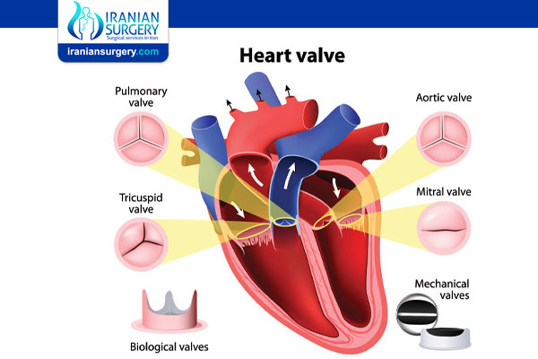Mitral Valve Replacement Open Heart Surgery