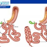 Modified Duodenal Switch