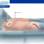 Who Is a Candidate for Minimally Invasive Mitral Valve Surgery?