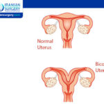 Bicornuate Uterus