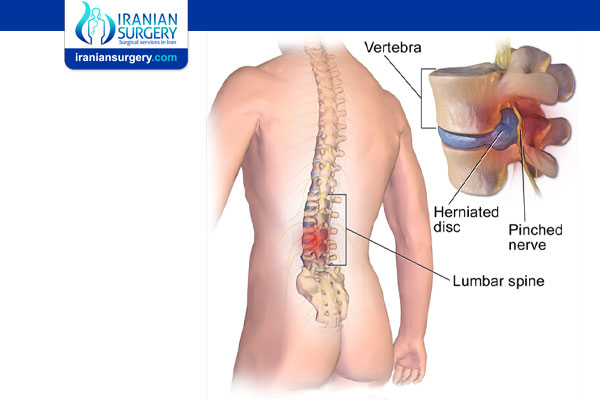 Microdiscectomy