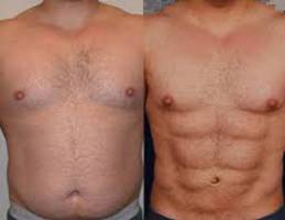 How Much Does Abdominal Etching Cost