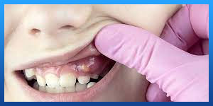 التهاب اللثة بعد زراعة الأسنان