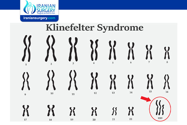 Are You Infertile If You Have Klinefelter Syndrome?
