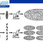 Micro TESE Sertoli Cell-Only